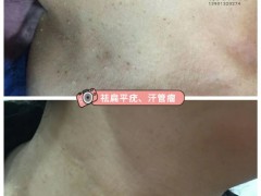 中医美容银针秀火针祛疣技术培训
